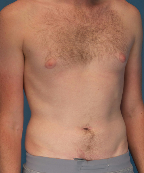 before gynecomastia right angle view male patient case 2797