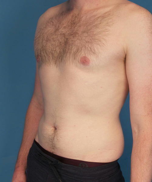 after gynecomastia left angle view male patient case 2797