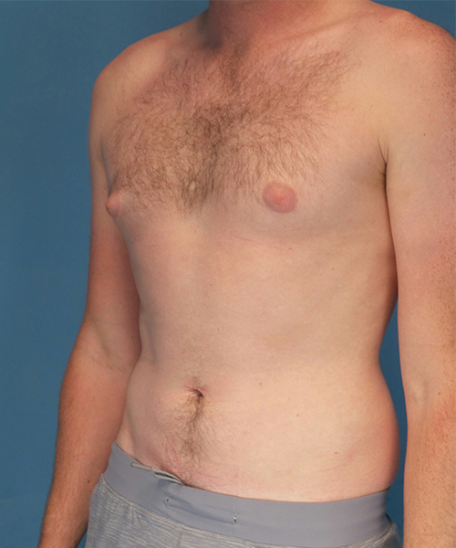 before gynecomastia left angle view male patient case 2797