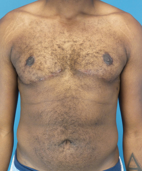 after gynecomastia front view male patient case 2808