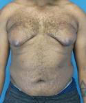 before gynecomastia front view male patient case 2808