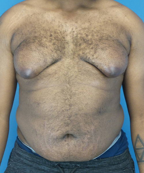 before gynecomastia front view male patient case 2808