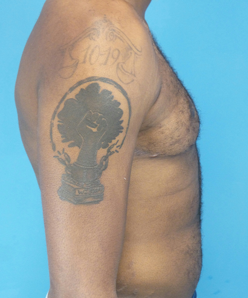 after gynecomastia right side view male patient case 2808