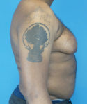 before gynecomastia right side view male patient case 2808
