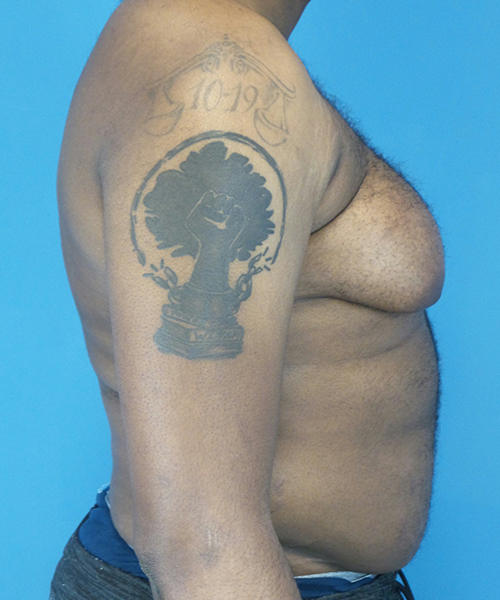 before gynecomastia right side view male patient case 2808