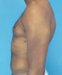 after gynecomastia left side view male patient case 2808