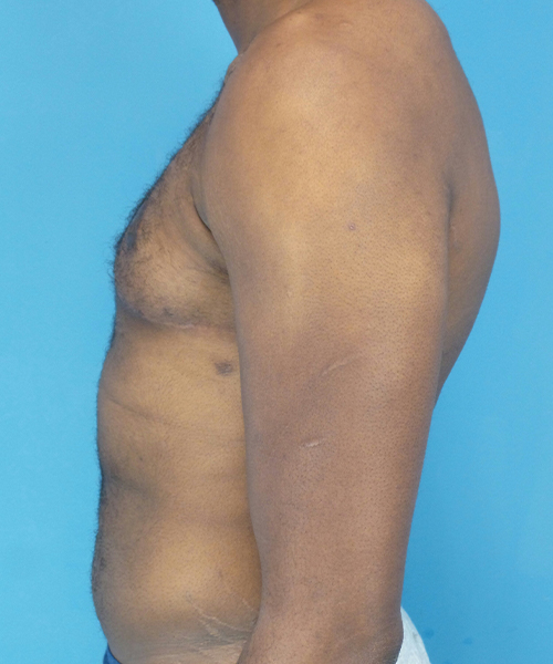 after gynecomastia left side view male patient case 2808