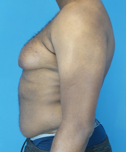 before gynecomastia left side view male patient case 2808