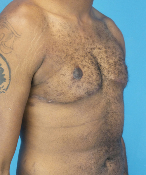 after gynecomastia right angle view male patient case 2808