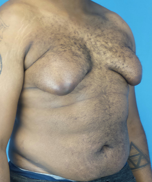before gynecomastia right angle view male patient case 2808
