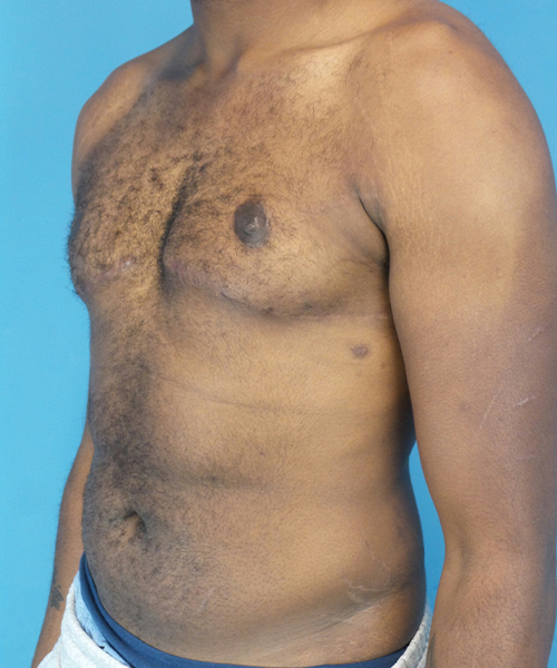 after gynecomastia left angle view male patient case 2808