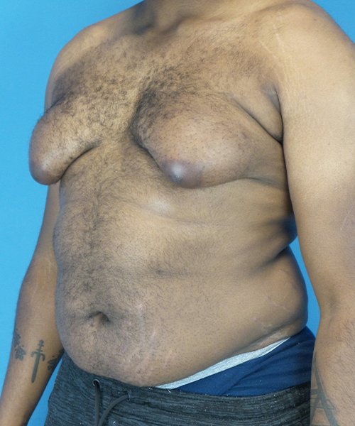 before gynecomastia left angle view male patient case 2808