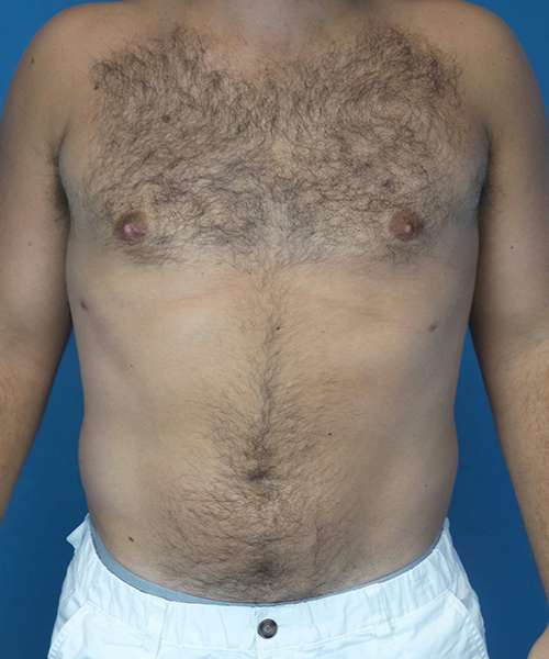 after gynecomastia front view male patient case 2819