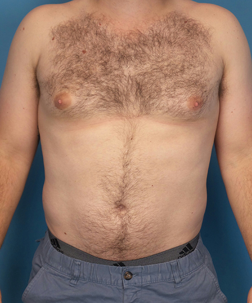 before gynecomastia front view male patient case 2819