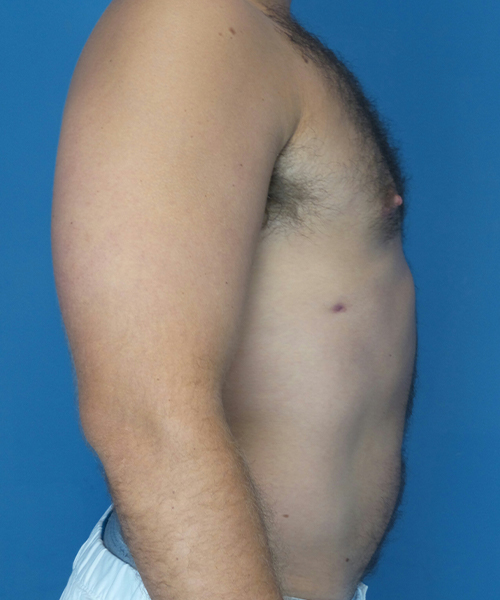 after gynecomastia right side view male patient case 2819