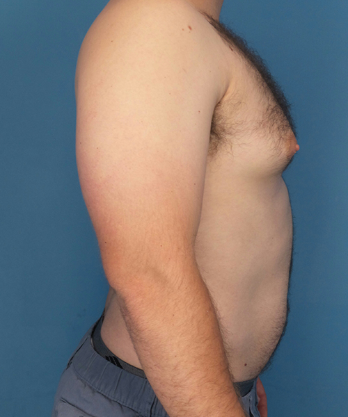before gynecomastia right side view male patient case 2819