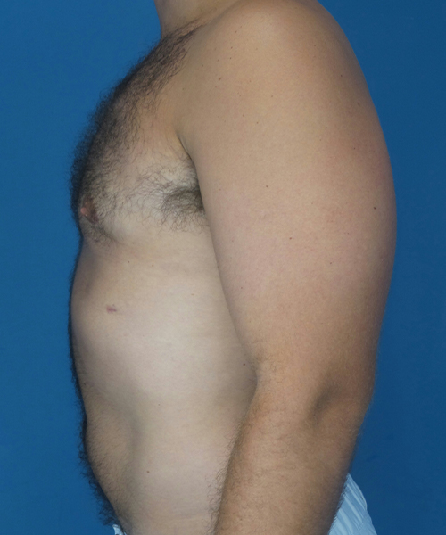 after gynecomastia left side view male patient case 2819