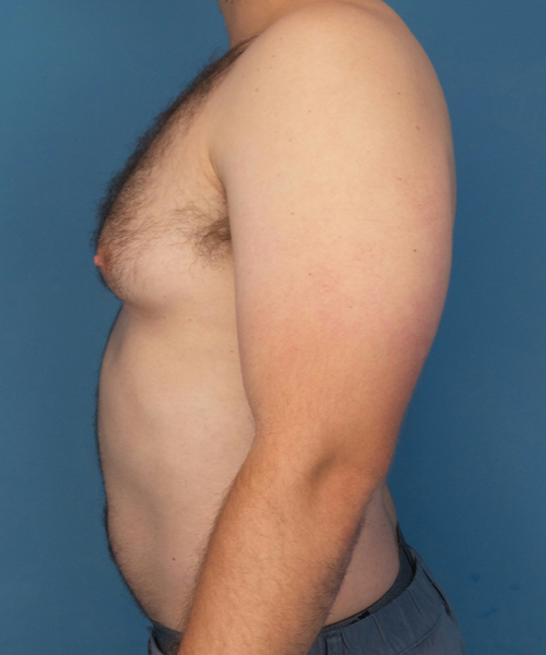 before gynecomastia left side view male patient case 2819