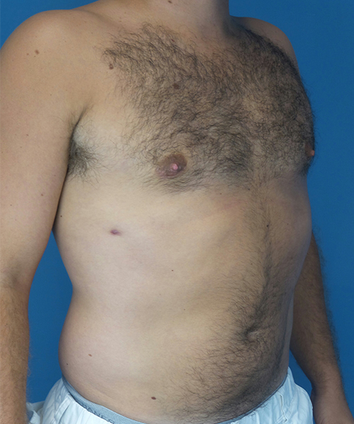 after gynecomastia right angle view male patient case 2819