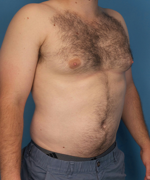 before gynecomastia right angle view male patient case 2819