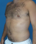 after gynecomastia left angle view male patient case 2819