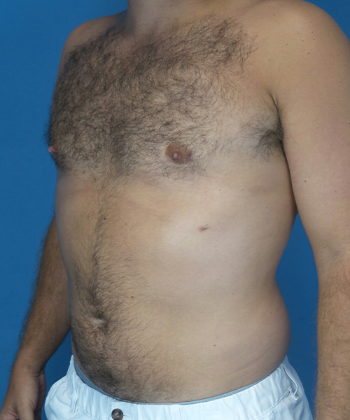 after gynecomastia left angle view male patient case 2819