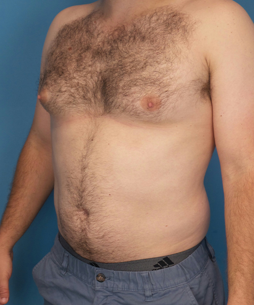 before gynecomastia left angle view male patient case 2819