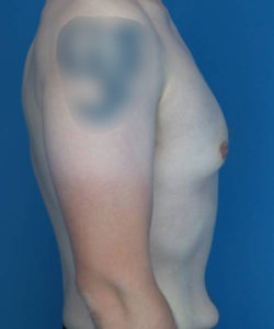 before gynecomastia right side view male patient case 1421
