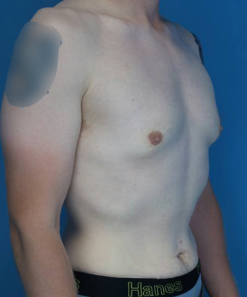 before gynecomastia right angle view male patient case 1421