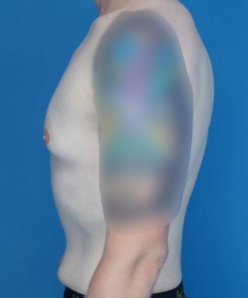before gynecomastia left side view male patient case 1421