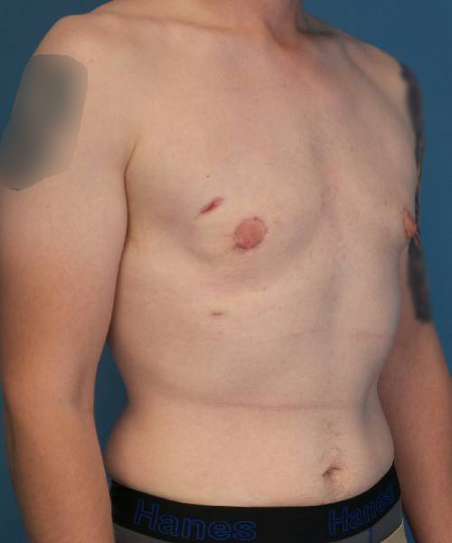 after gynecomastia right angle view male patient case 1421