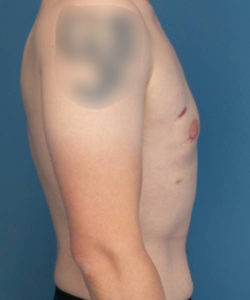 after gynecomastia right side view male patient case 1421