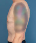 after gynecomastia left side view male patient case 1421