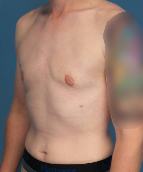 after gynecomastia left angle view male patient case 1421