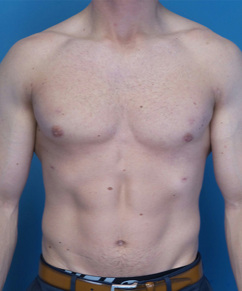 after gynecomastia front view case 4909