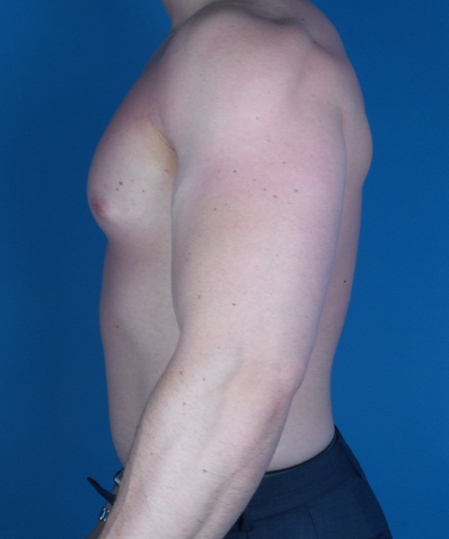 before gynecomastia side view case 4909