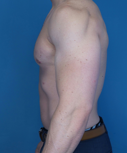 after gynecomastia side view case 4909