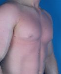 before gynecomastia right angle view case 4909