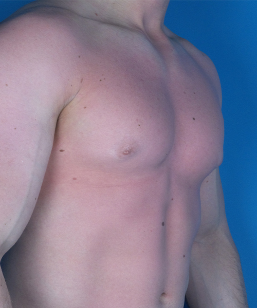 before gynecomastia right angle view case 4909