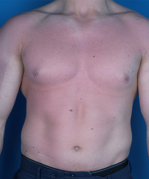 before gynecomastia front view case 4909