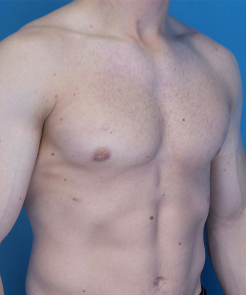 after gynecomastia right angle view case 4909