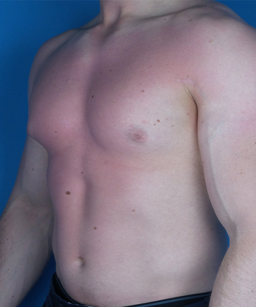 before gynecomastia angle view case 4909