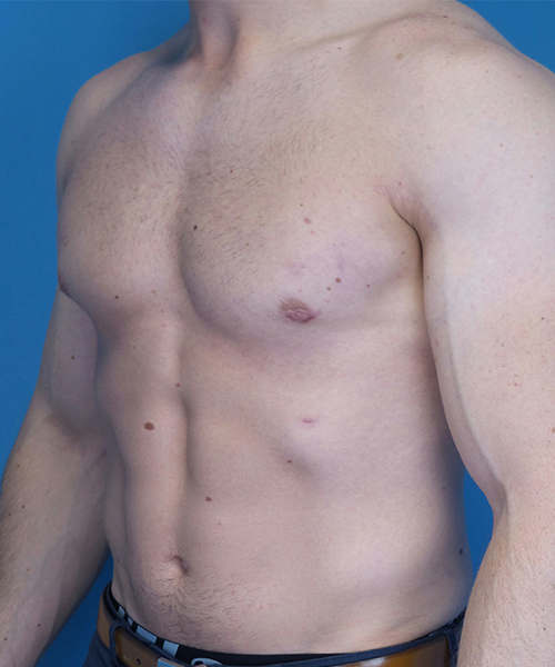 after gynecomastia angle view case 4909