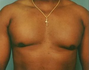 before gynecomastia front view case 4918