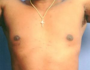 after gynecomastia front view case 4918