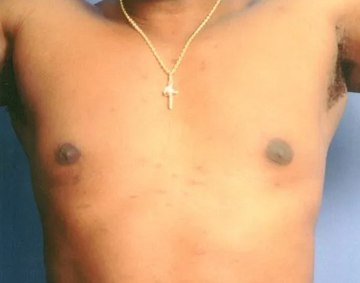 after gynecomastia front view case 4918