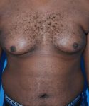 before gynecomastia front view case 4932