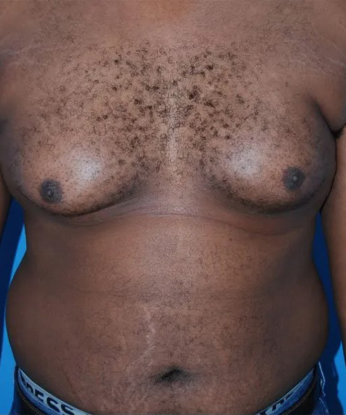 before gynecomastia front view case 4932