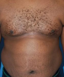 after gynecomastia front view case 4932