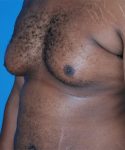 before gynecomastia angle view case 4932